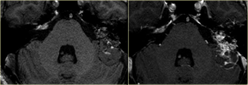EndoLymphatic Sac Tumor: T1WI before and after i.v. contrast