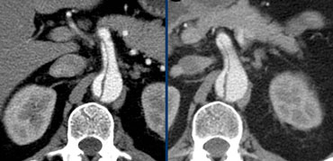 LEFT: Dissected SMARIGHT: No change at 20 months follow up