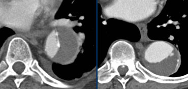 LEFT: Dissection with a thrombosed false lumen. RIGHT: Aneurysm with thrombus on the inner side of the intimal calcifications.