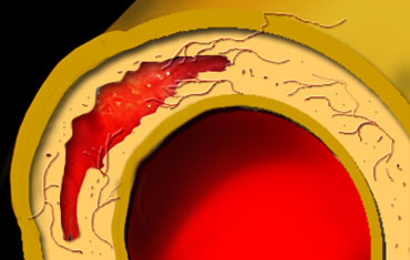 Intramural Hematoma is a result of ruptured vasa vasorum
