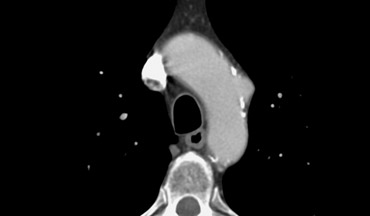 Typical illustration of PAU, focal outpouchings of contrast, separating extensive intimal calcifications