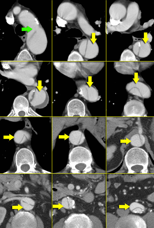 Type B dissection. Green arrow indicates entry. False lumen is indicated by yellow arrows and is seen spiraling around the true lumen.