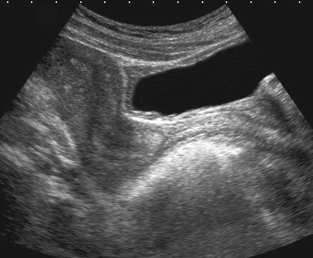 abnormal transvaginal ultrasound