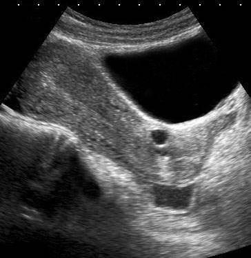 urethral diverticulum ultrasound