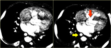 Mirror image aortic arch (yellow arrow) and a VSD (red arrow)