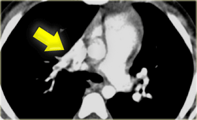 Right upper lobe anomalous vein drains into the superior vena cava.
