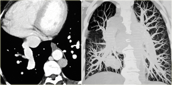 Scimitar syndrome with a hypoplastic right lung.