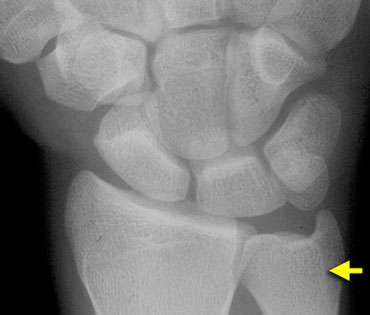 Extensor carpi ulnaris groove (yellow arrow) seen radial to the midportion of the ulnar styloid.