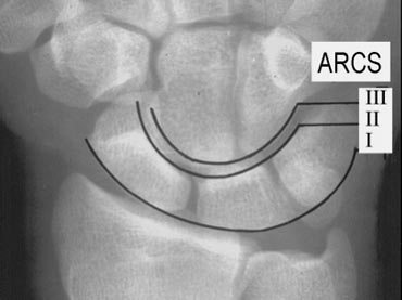 PA radiograph of the wrist. The three normal carpal arcs