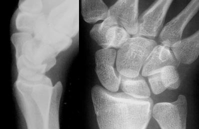 LEFT: Lateral radiograph of the wrist in extention showing scaphoid elongationRIGHT: PA radiograph of the wrist in ulnar deviation showing elongation of the scaphoid