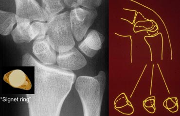 LEFT: PA radiograph of the wrist in radial deviation showing foreshortening of the scaphoid: signet ring signRIGHT: Schematic representation of the wrist in flexion showing tilting of the scaphoid towards the palm