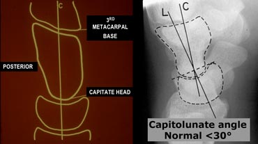 LEFT: Capitate axisRIGHT: Radiograph with lunate and capitate axis drawn.