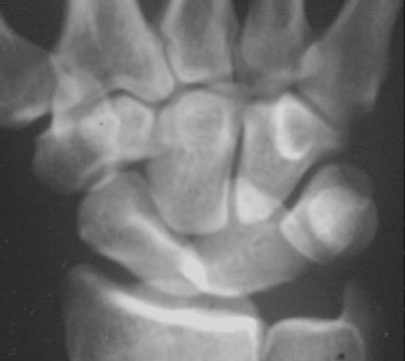 PA and lateral view of the wrist