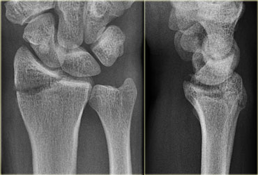 colles fracture xray