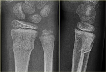 Colles fracture, Radiology Case