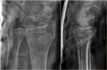 Good alignment after closed recuction for extraarticular Colles fracture