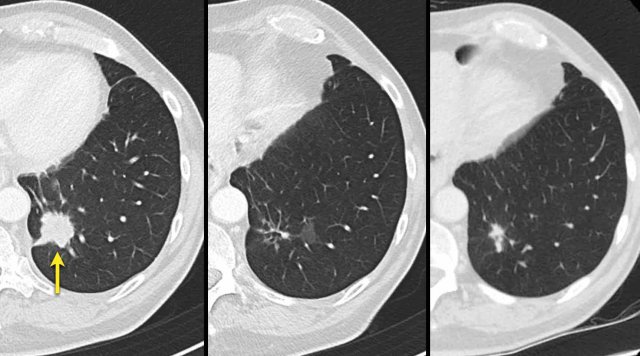 CT images in a 72-year-old male with recurrent esophageal carcinoma and a re-appearing lung metastasis.