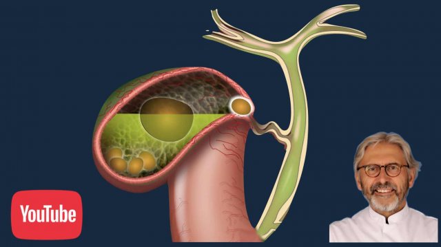 US of Acute Cholecystitis