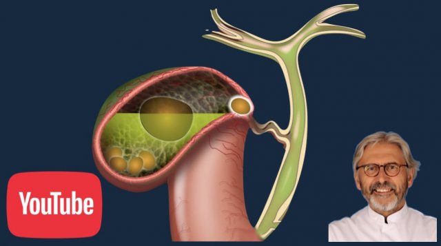US of Acute Cholecystitis