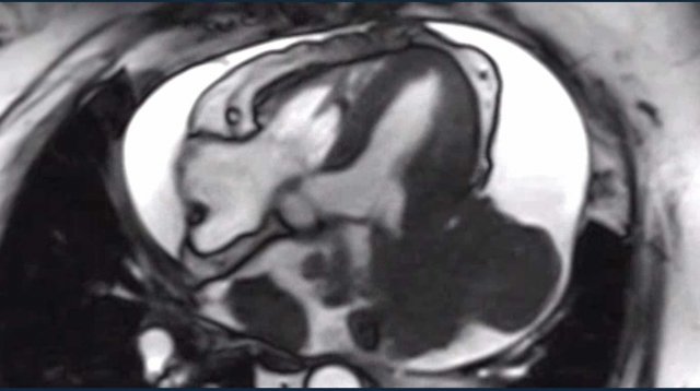 Cardiac Masses: Tumors and Mimics