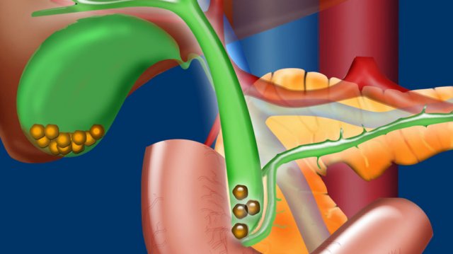 Common Bile Duct Stones - Ultrasound