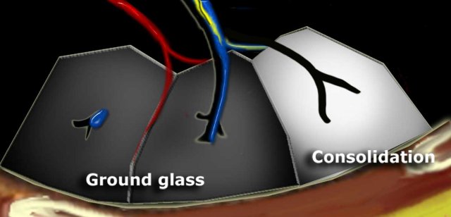 Dark bronchus sign in ground glass opacity. Complete obscuration of vessels in consolidation and air bronchogram.