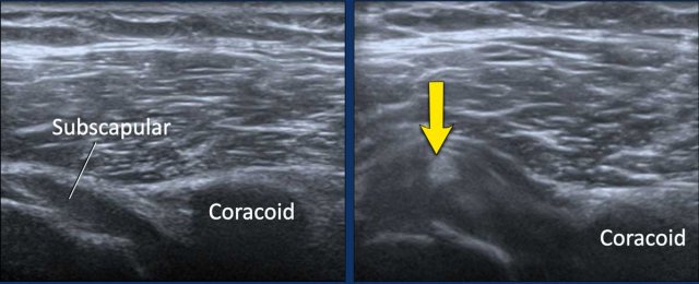 Image during exoratation (left) and endorotation (right)