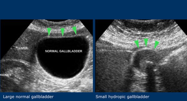 diseased gallbladder ultrasound