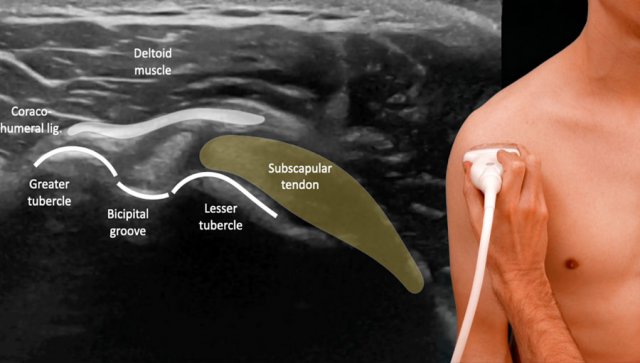 Shoulder Ultrasound