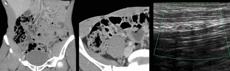 The Radiology Assistant : Appendicitis - Pitfalls in US and CT diagnosis