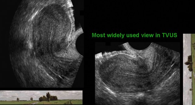 retroverted uterus transabdominal ultrasound