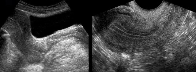 Normal empty uterus in ectopic pregnancy