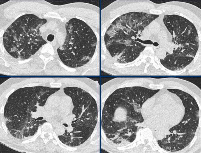 The Radiology Assistant : 32 cases of suspected COVID-19