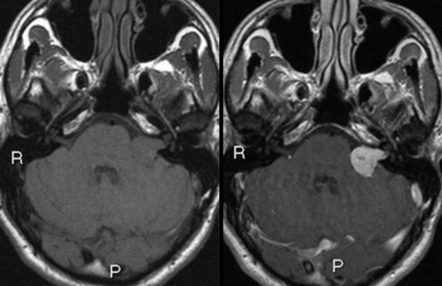 Left sided vestibular schwannoma. Axial non contrast-enhanced T1-W (left) and contrast-enhanced images (right).