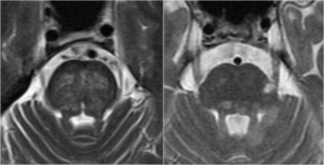 Brainstem involvement in small vessel disease (left). Focal brainstem lesions in MS (right).