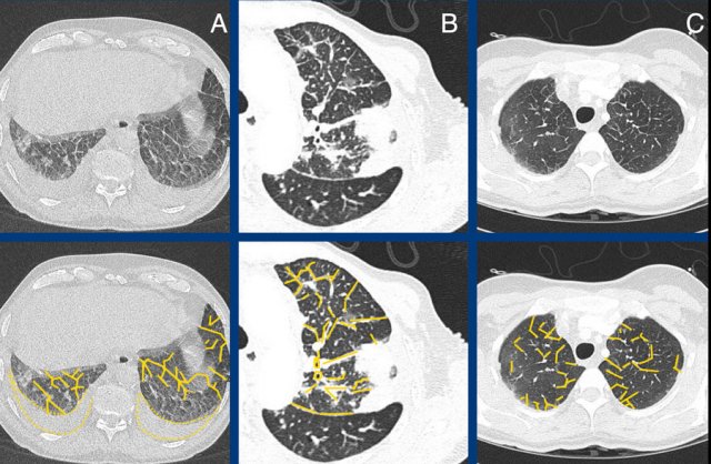 pulmonary fibrosis