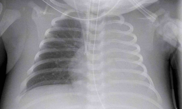 Complete atelectasis of the left lung