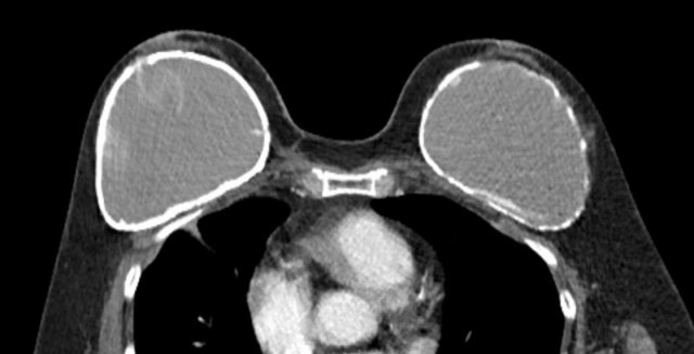 Capsular calcifications. Possible intracapsular rupture of the breast implant on the right.