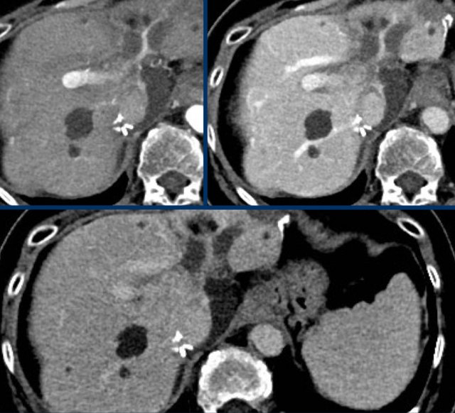 Non enhancing lesions in a cirrhotic liver, compatible with cysts, LR-1