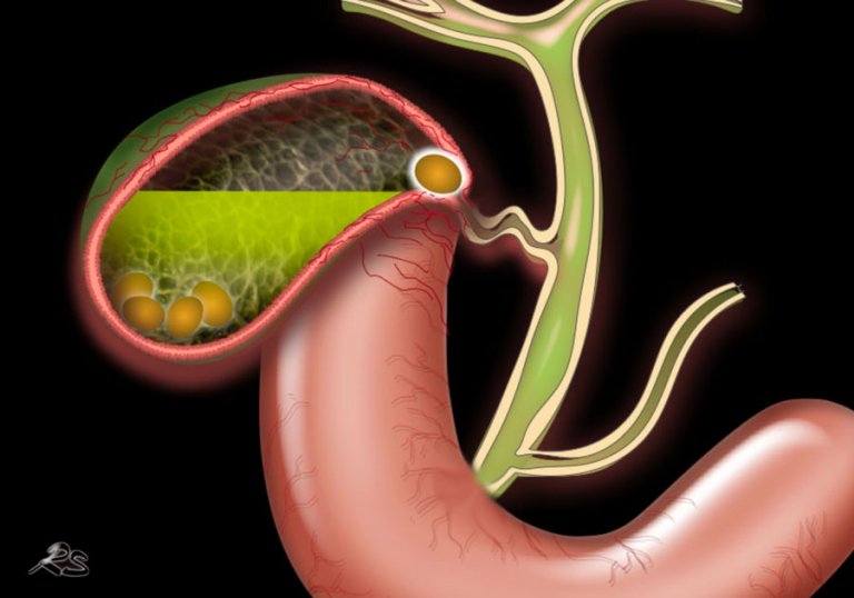 The Radiology Assistant : Gallbladder obstruction