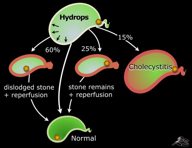 Follow up in 100 patients presenting with acute hydrops at the ER  treated with spasmolytics and not immediately operated. In 15 acute cholecystitis developed. In 25 the stone remained in place, but bile can pass and hydrops disappears. In 60 patients the stone becomes dislodged and the galbladder returns to normal sometimes with a period of reperfusion edema.