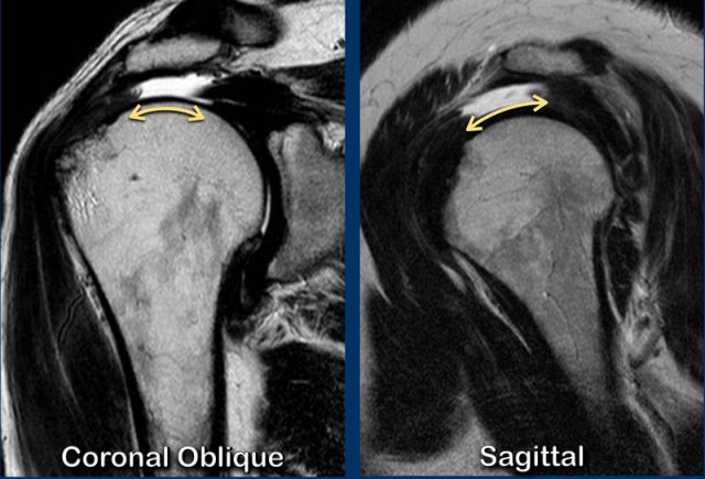 The Radiology Assistant : Shoulder - Rotator cuff injury