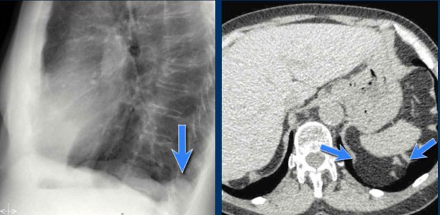 Bochdalek hernia