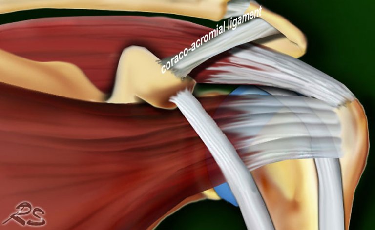 The Radiology Assistant : Shoulder - Rotator cuff injury