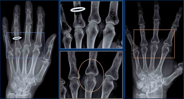 Two examples of periarticular osteopenia in rheumatoid arthritis. Click on image to enlarge.