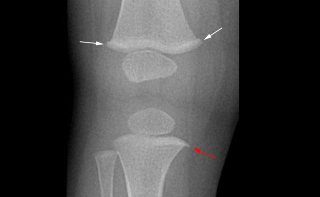 bucket handle fracture