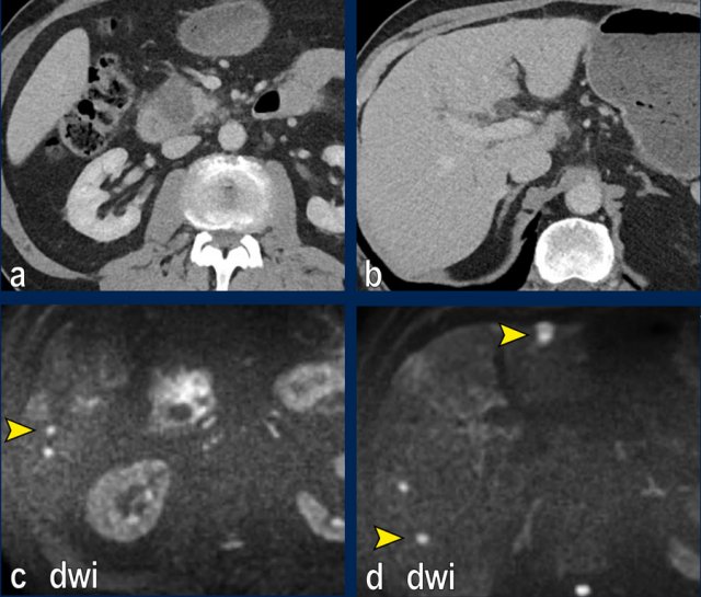Liver metastases shown on DWI but not on CT (arrowheads).