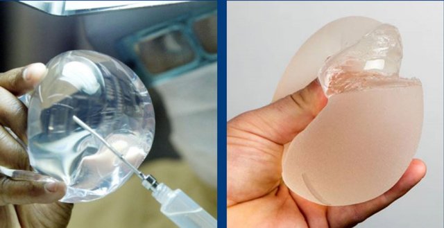 Saline filled implant and a silicone filled implant which is cut to show the form-stable content.