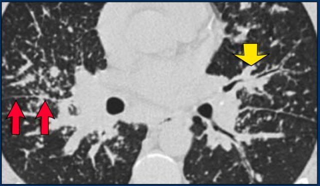 Sarcoidosis: typical presentation with nodules along the bronchovascular bundle and fthe issuresNotice the partially calcified node in the left hilum.