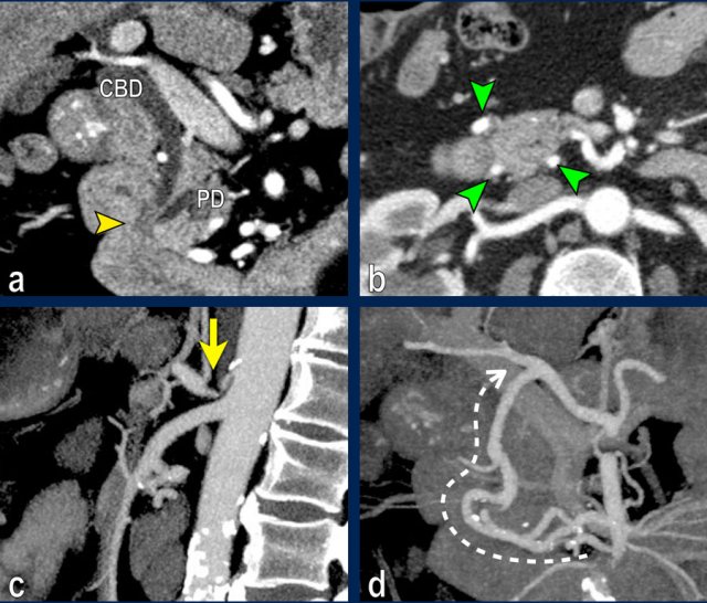 Celiac trunc stenosis with collateral bloodflow to the hepatic artery via the pancreaticoduodenal arcade.